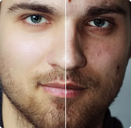 Acne & Blemish Ultimate Bundle